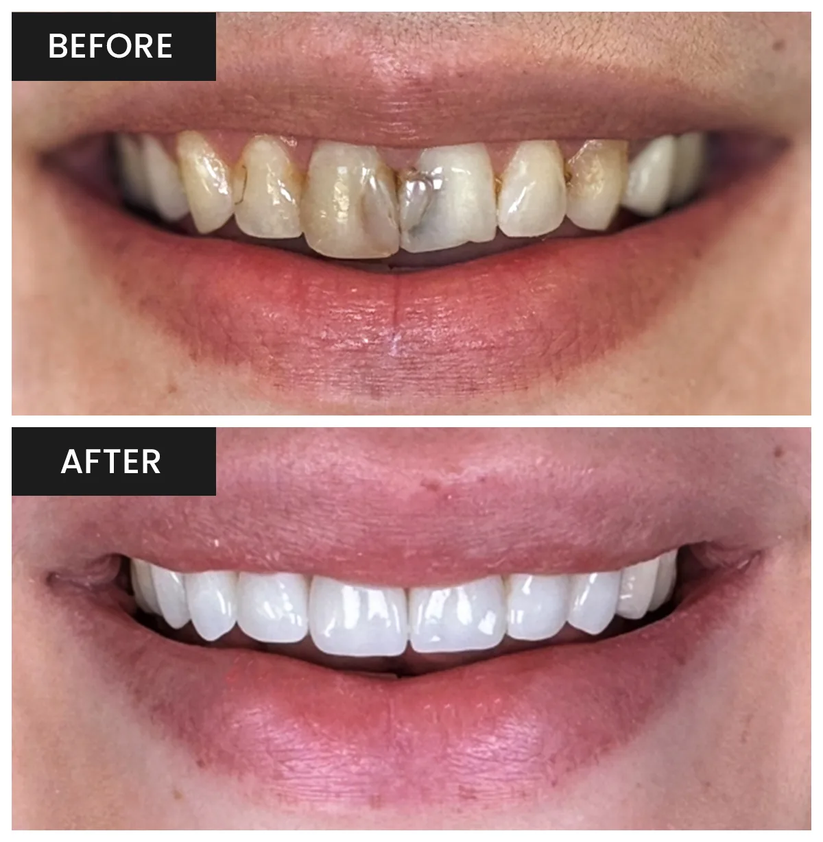 Amber's Smile Transformation - Custom Veneers & Crowns