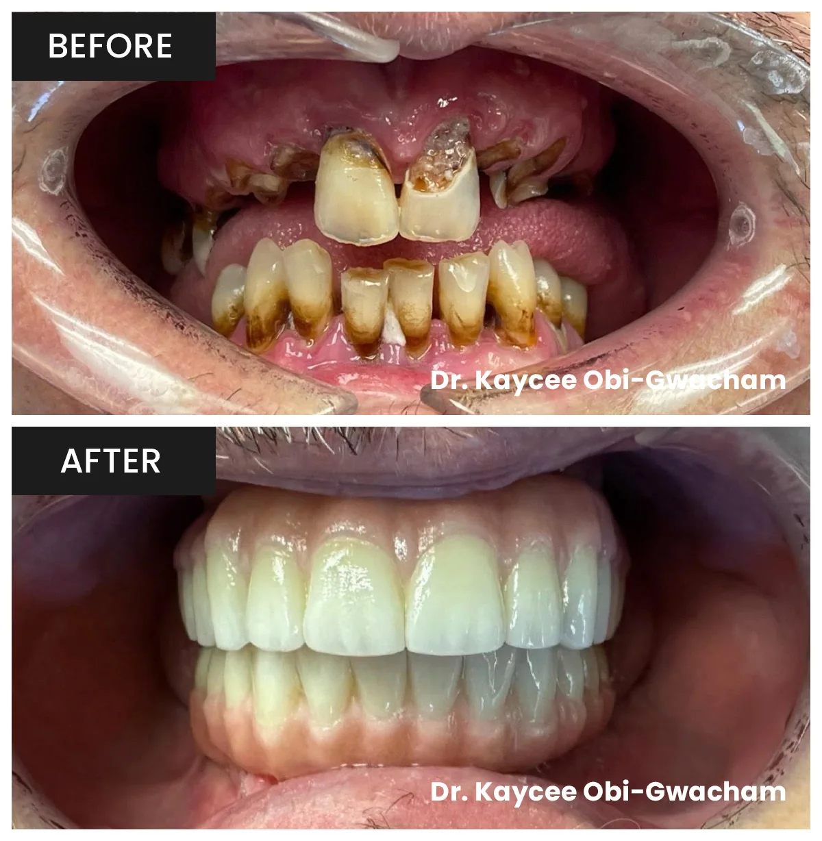 Chris's Smile Transformation - Full-Arch Dental Implants
