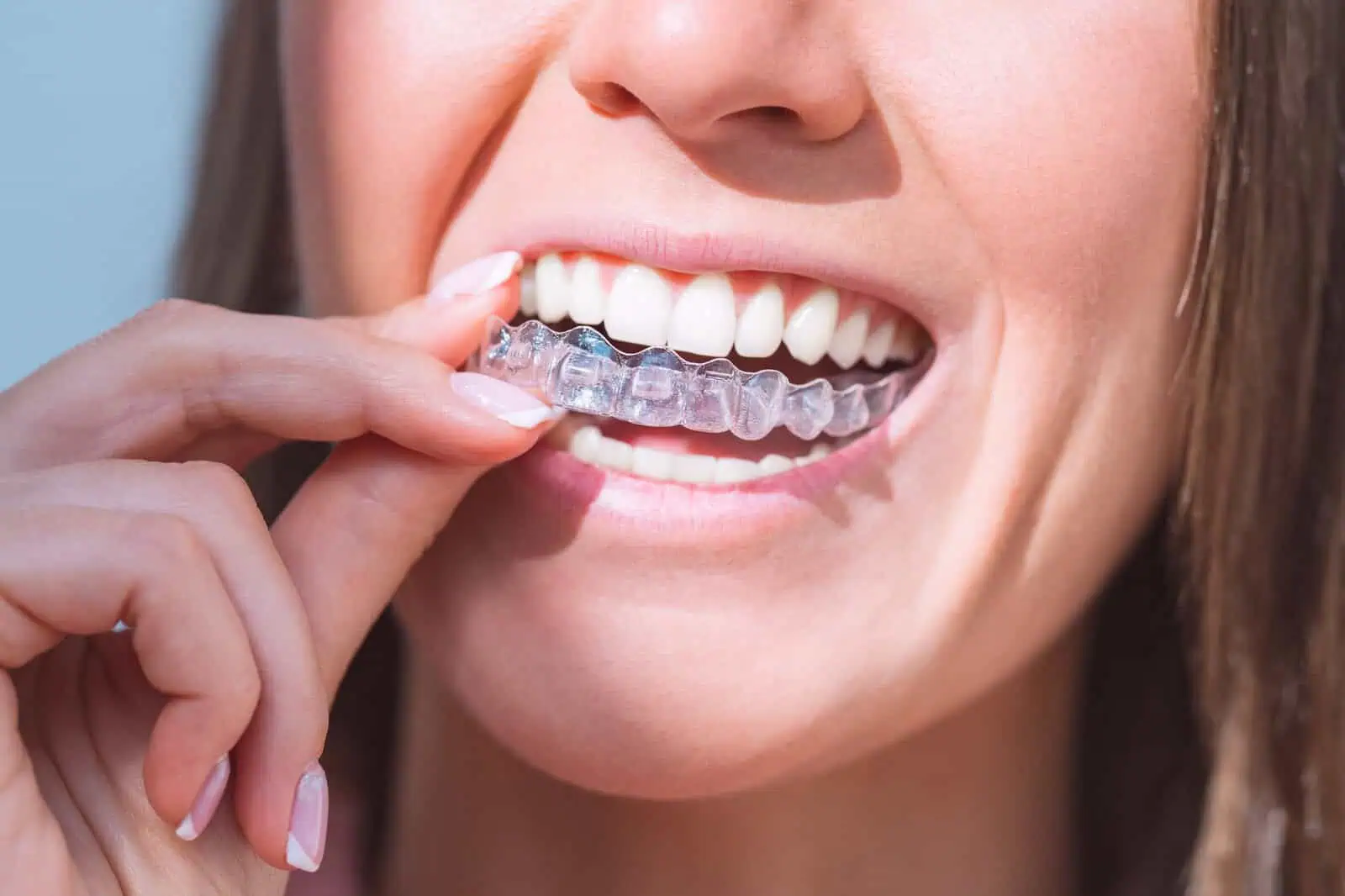 Invisalign Aligners at Southern Charm Dentistry