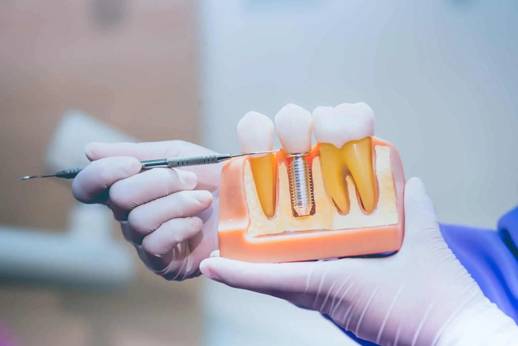Dental Implants at Southern Charm Dentistry