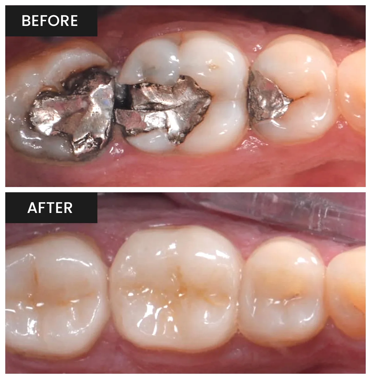 Mike's Smile Transformation - Tooth-Colored Restorative Fillings