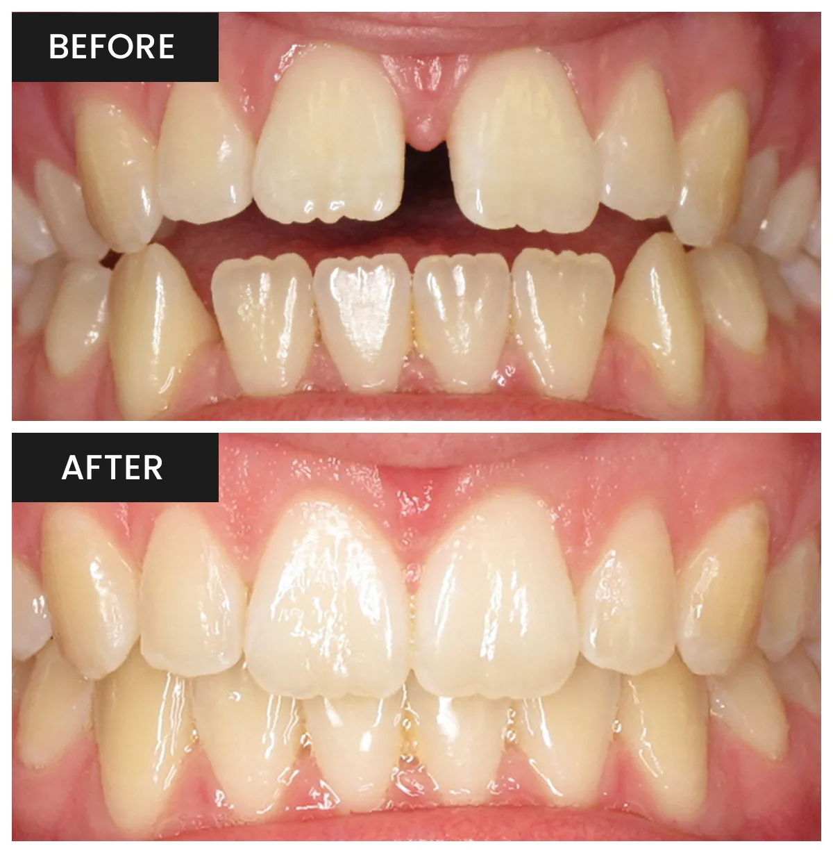 Oliver's Smile Transformation - Invisalign Clear Aligners