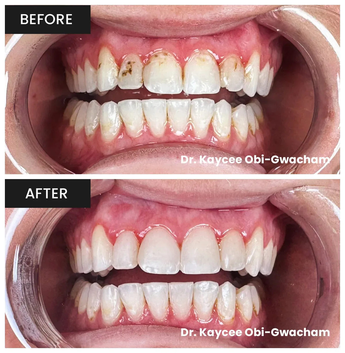 Rebecca's Smile Transformation - Composite Bonding