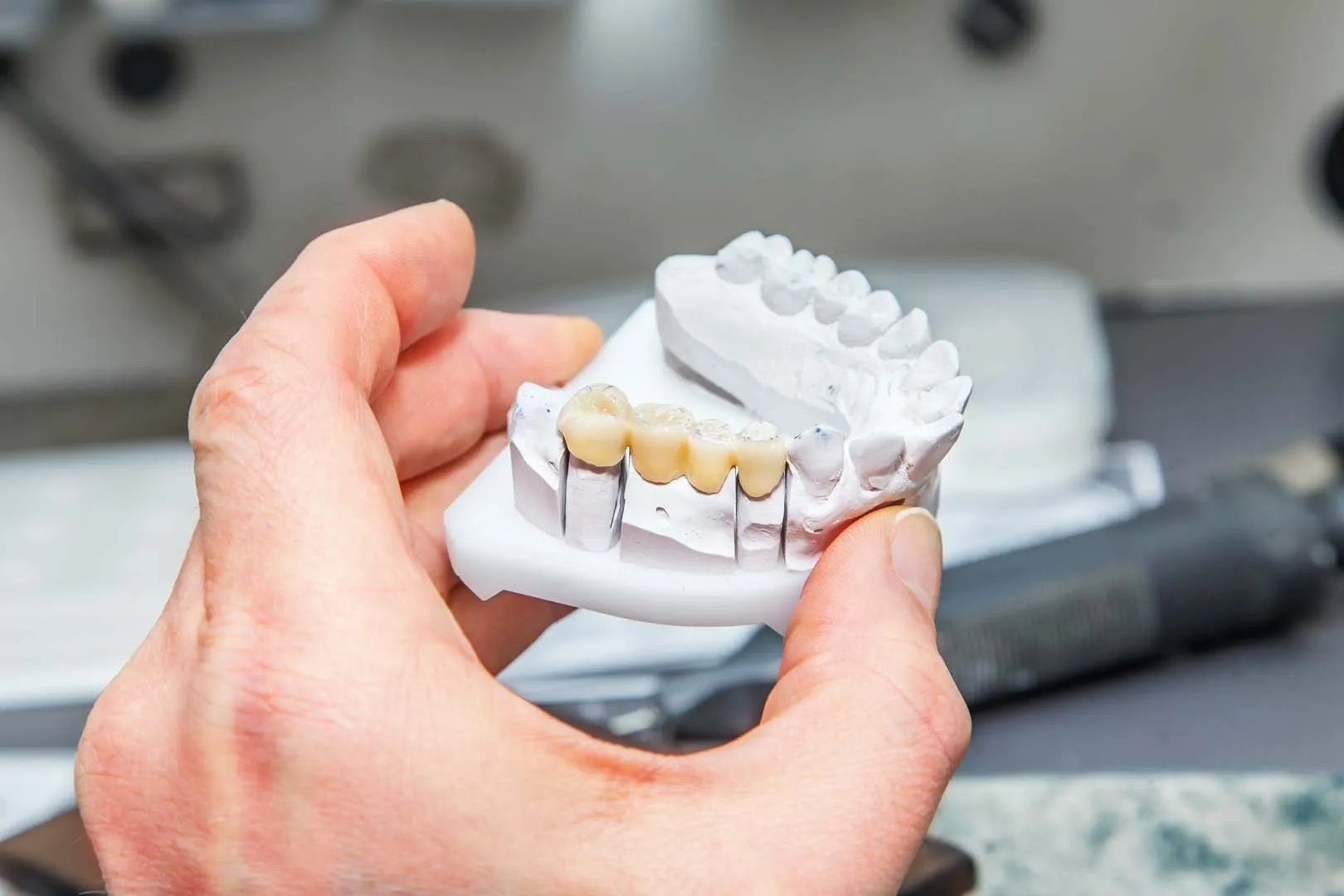 Dental bridge restoration