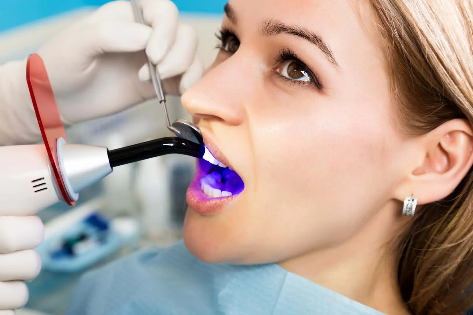 Tooth-coloured dental filling