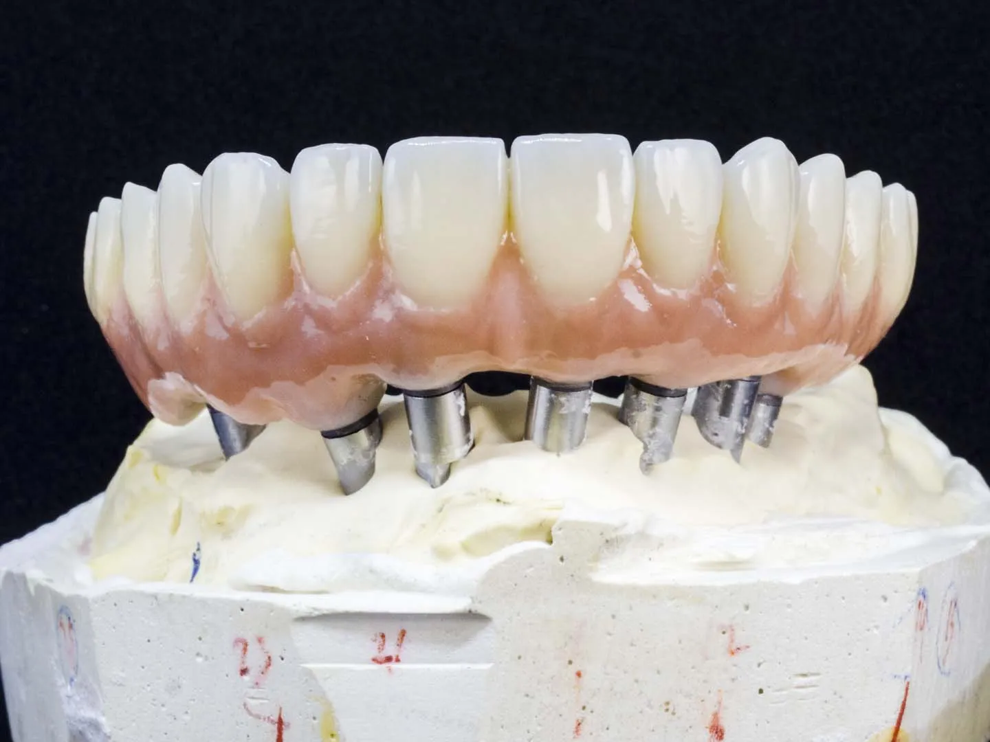 Implant-supported dentures