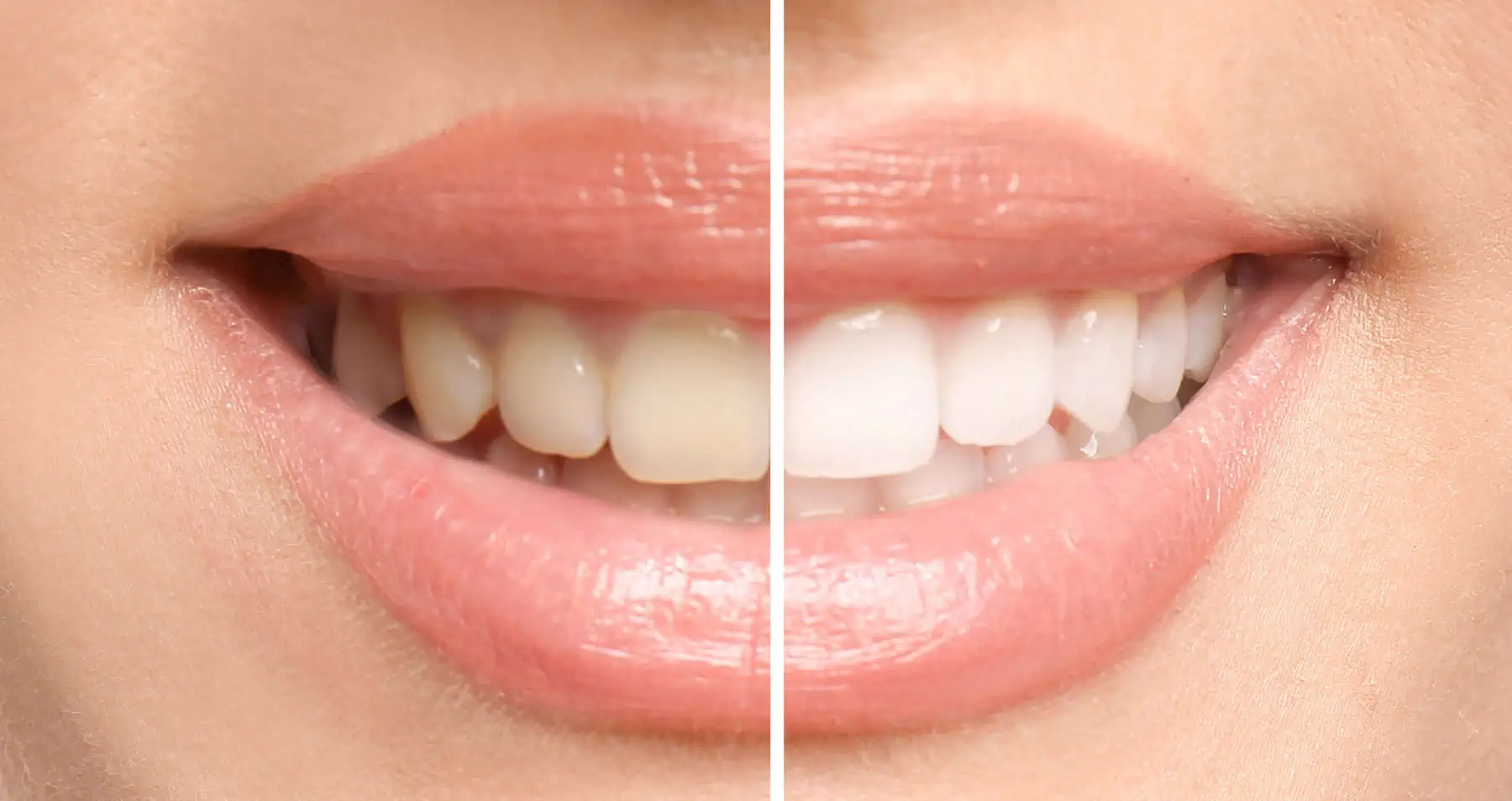 Professional teeth whitening treatment
