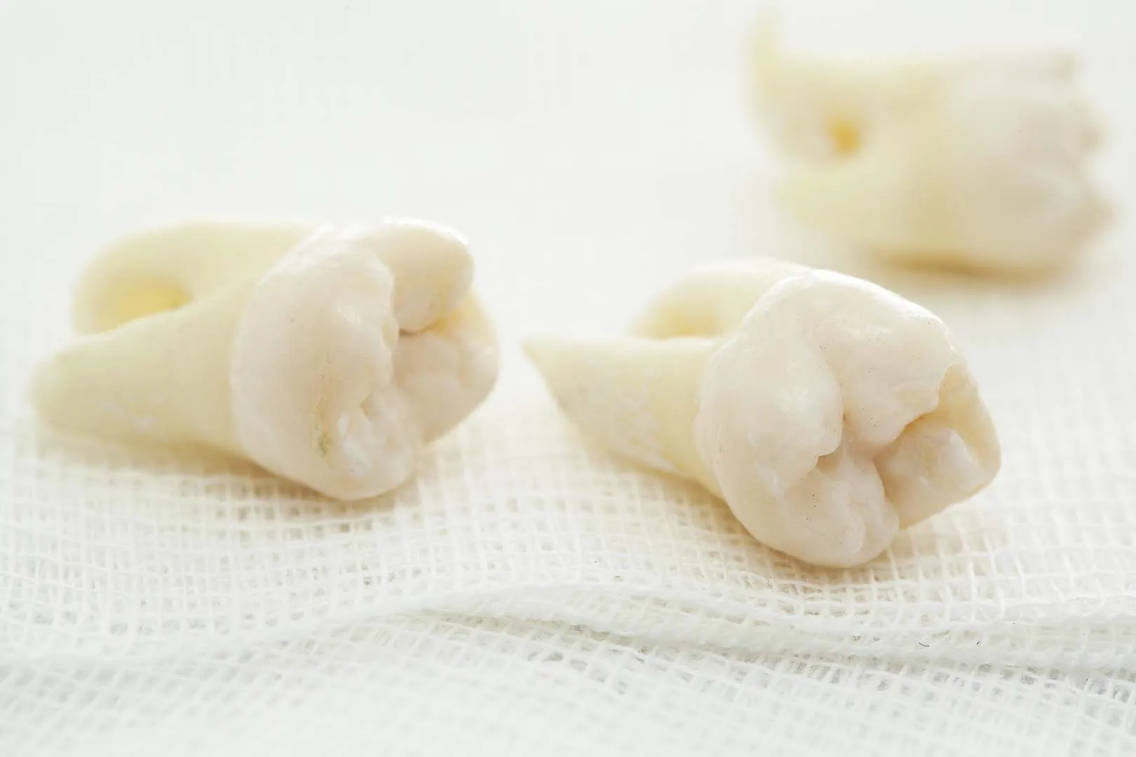 Wisdom teeth removal